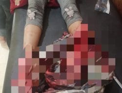 Siswi Kelas 3 SD di Bone Ditabrak Truk PLN, Kedua Pergelangan Kaki Luka Parah